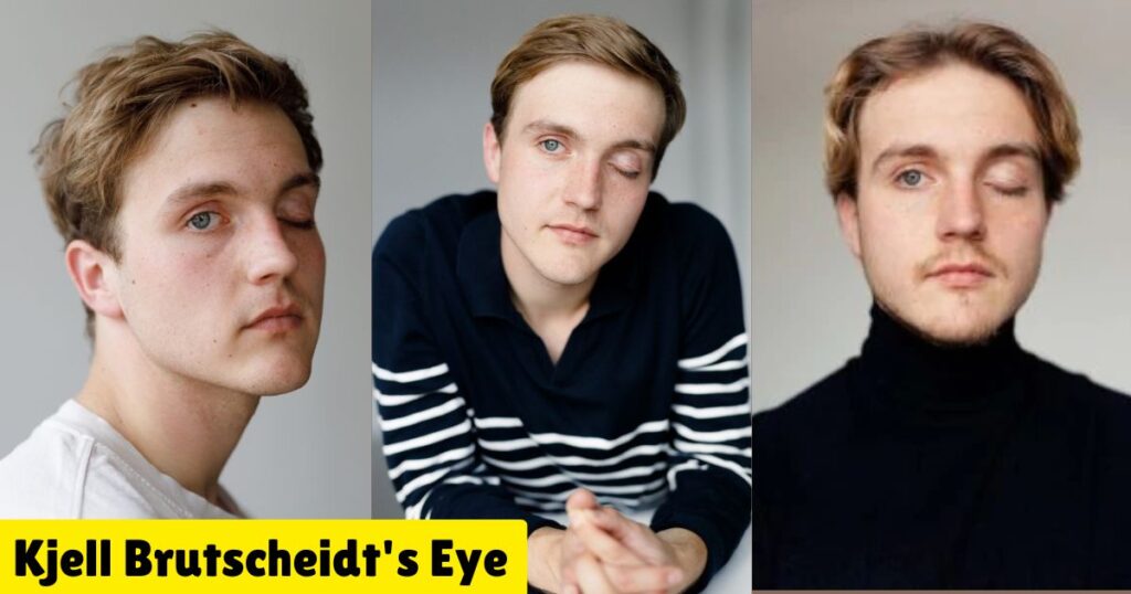 Kjell Brutscheidt's Eye: Unraveling the Mystery Behind the Rising Star's Unique Look