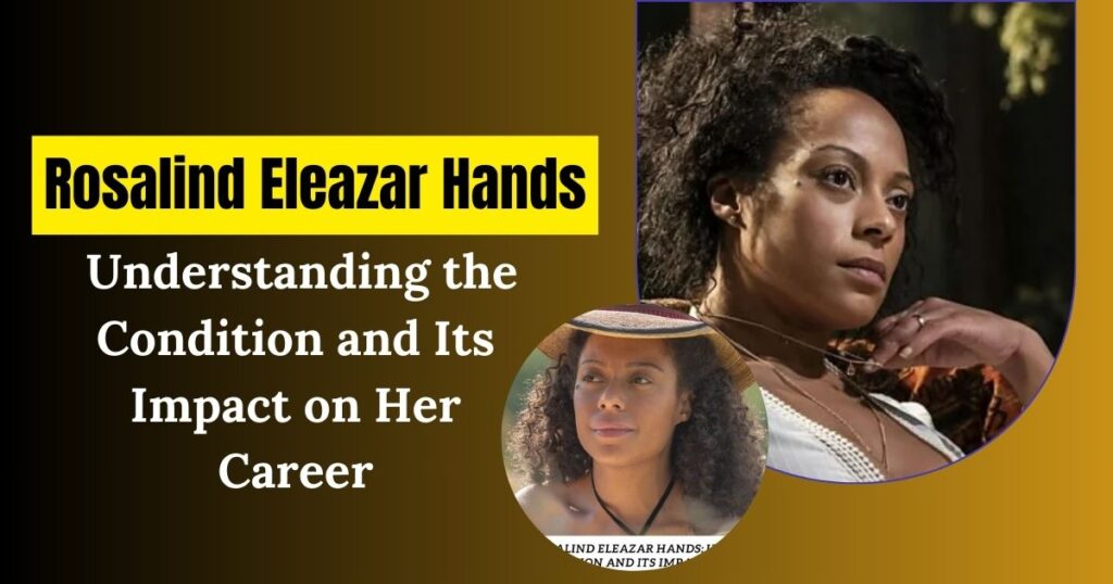 Rosalind Eleazar Hands: Understanding the Condition and Its Impact on Her Career