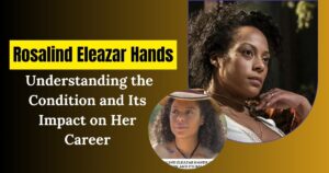 Rosalind Eleazar Hands: Understanding the Condition and Its Impact on